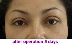 plastic-surgery-blepharoplasty